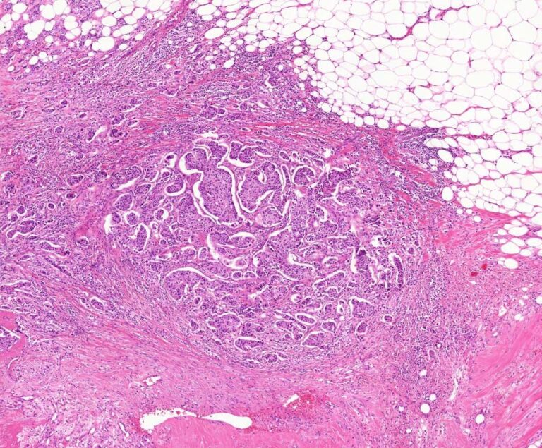 european-breast-cancer